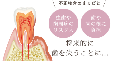 不正咬合のままだと「虫歯や歯周病のリスク大」「歯や歯の根に負担」将来的に歯を失うことに…