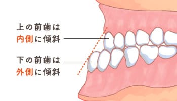 上の前歯は内側に傾斜 下の前歯は外側に傾斜