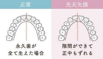 正常（永久歯が全て生えた場合）／先天欠損（隙間ができて正中もずれる）