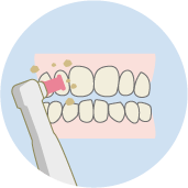 歯のクリーニング歯垢・歯石を除去