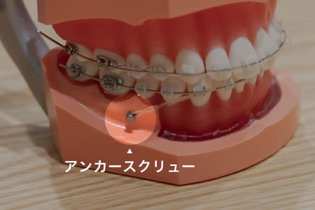 矯正治療の期間が短縮できる？アンカースクリューのいいところ | 藤崎