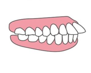上顎前突のイラスト